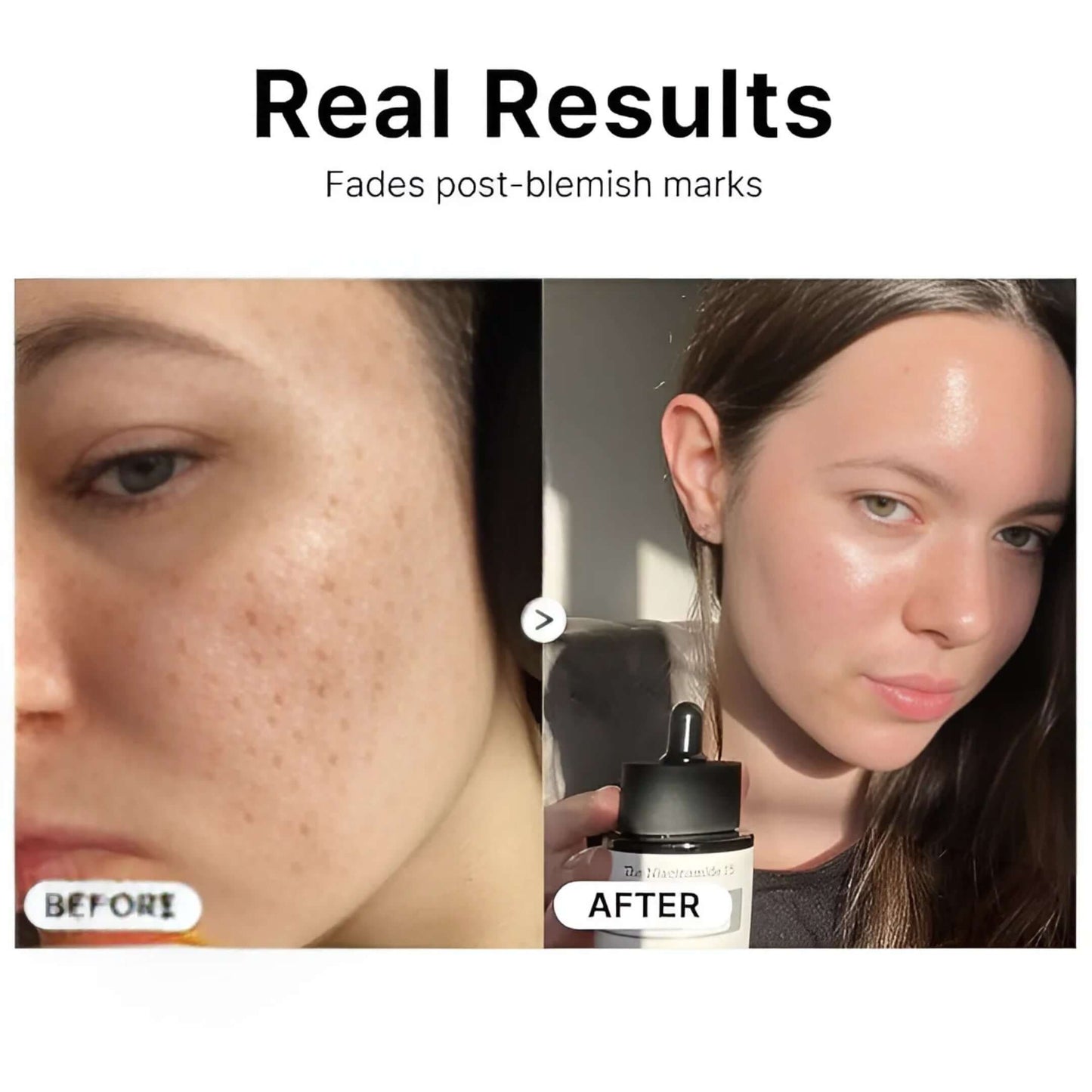 Yapidra Niacinamide Pore-Refining Serum – Controls Oil & Reduces Acne Scars